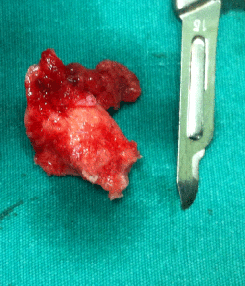 Figure 3: Macroscopically the mass is solid and white-grayish in color.